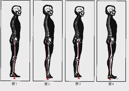 开yun体育官网入口登录app 膝过伸机制及治疗方法总结