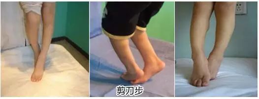 开yun体育app官方下载入口 家庭康复训练：剪刀步态、下肢屈膝、膝反张、尖足，足内外翻的训练