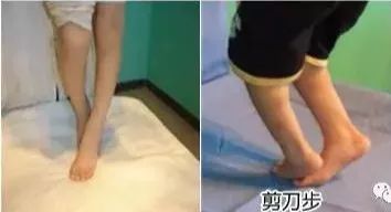 开yun体育官网入口登录app 【康复】剪刀步态康复训练方法