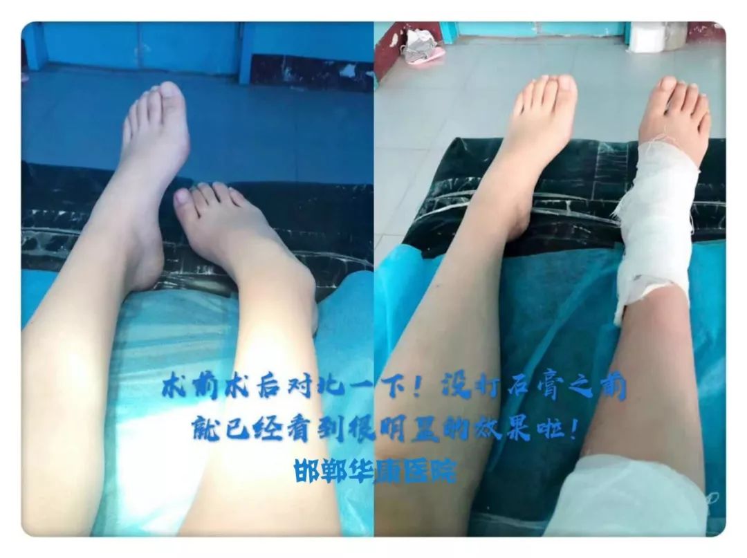 髋关节训练器的适应症_髋关节训练椅_髋关节训练器