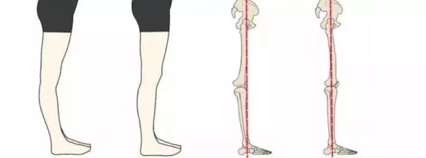 开yun体育官网入口登录体育 脑卒中康复训练不要忽视“膝过伸”（附:实用康复训练图解）