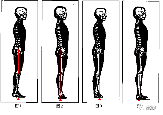 开yun体育app入口登录 【膝盖康复】膝过伸？！超经典病因机制及治疗方法总结