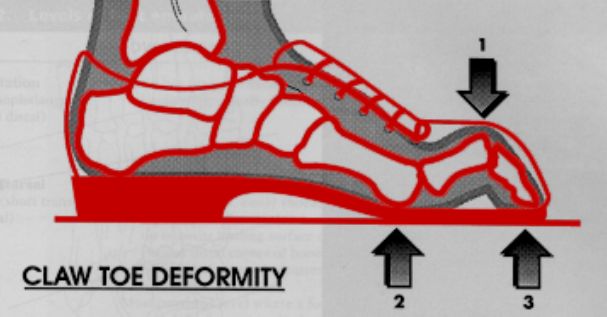 开yun体育官网入口登录app 常见异常步态及矫治方法