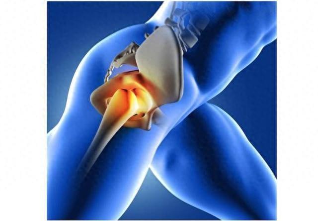 kaiyun体育 全髋关节置换术中如何操作可以有效避免假体脱位？