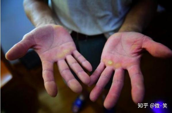 开yun体育app入口登录 单杠经常磨泡，怎样避免，健身手套有用么，有的话给推荐下？