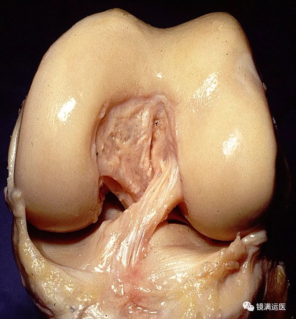kaiyun官方网app下载app 膝关节前交叉韧带重建术后的康复训练
