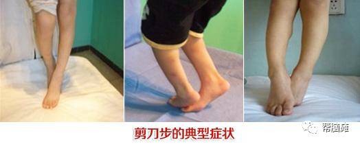 妖精漫画免费登录入口界面下拉式 脑瘫患儿剪刀步应该如何做康复训练