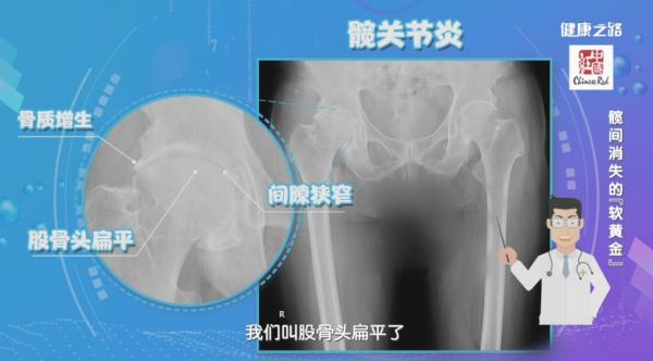 髋关节骨性关节炎症状_髋关节训练椅_运动损伤髋关节怎么办