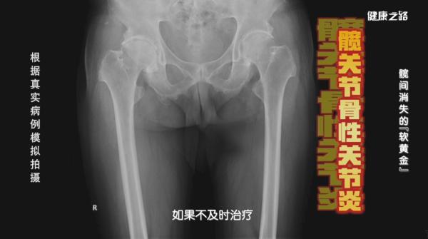 开yun体育官网入口登录app 你的髋关节还好吗？3个小测试速来检查