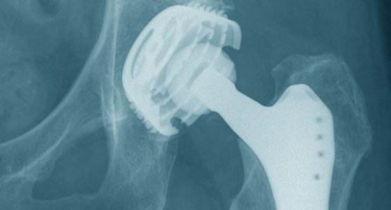 髋关节坐姿_髋关节训练椅_髋关节训练器的适应症