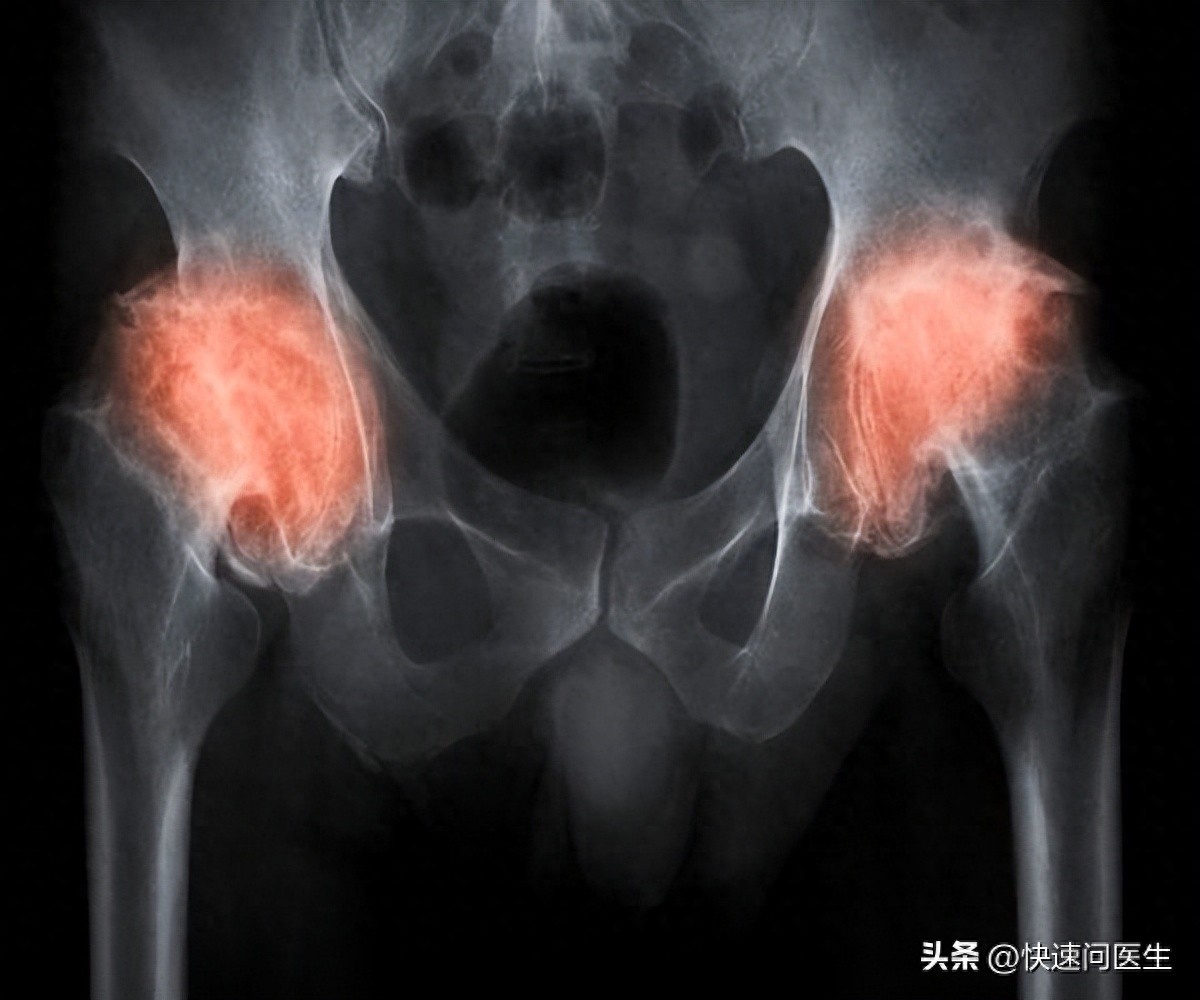 开yun体育官网入口登录app 为了保护髋关节健康，需要注意哪些细节？这份保养指南请收好