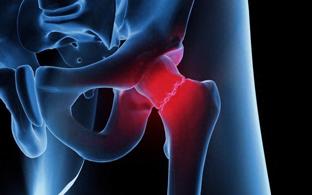 开yunapp体育官网入口下载手机版 科普｜做好家庭护理让生活 “髋” 然一新：人工髋关节置换术后的家庭护理