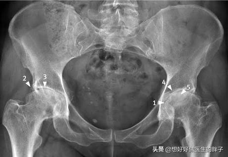 髋关节训练椅_髋关节疼痛康复锻炼_髋关节疼痛检查方法
