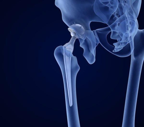 开yunapp体育官网入口下载手机版 髋关节痛蹲不下怎么办呢