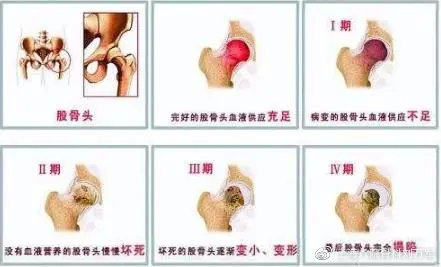 髋关节训练椅_髋关节训练器_髋关节训练器的适应症
