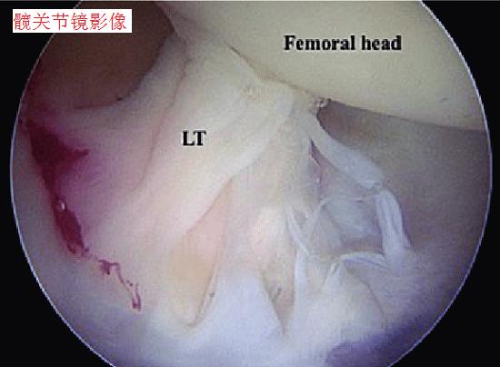 髋关节镜影像