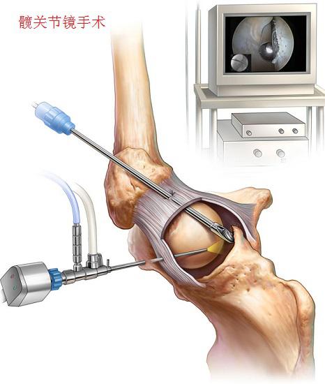 髋关节镜手术
