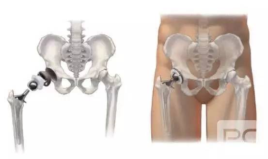 开yun体育官网入口登录app 髋关节置换后训练小结