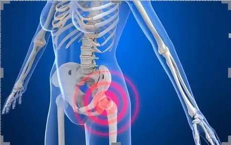 髋关节置换术适应症 _ 人工关节置换术前准备 _髋关节训练椅