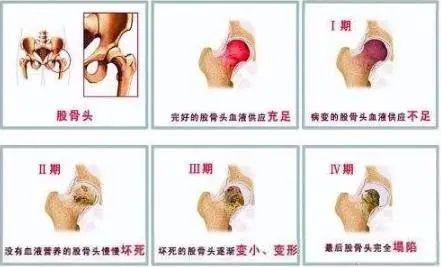_髋关节训练椅_ 髋关节置换手术过程